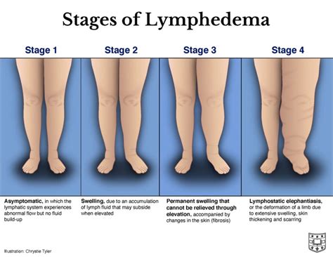 Lymphoedema